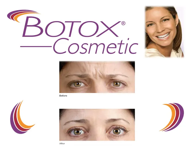 Botox Cosmetic before and after of frown lines and crow's feet