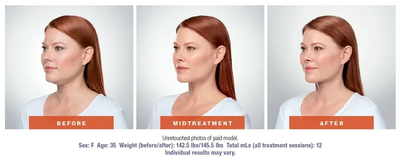 Kybella treatment before and after for fullness under the chin